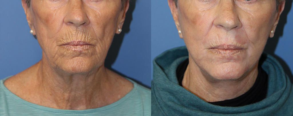 Facial Plastic Surgery Procedures - Uassex