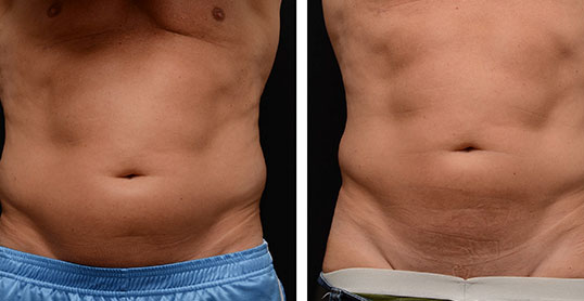 CoolSculpting Results