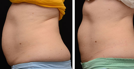 CoolSculpting Results