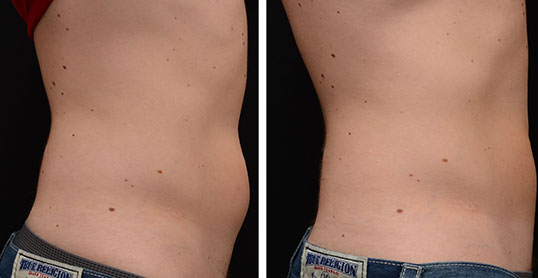 CoolSculpting Results