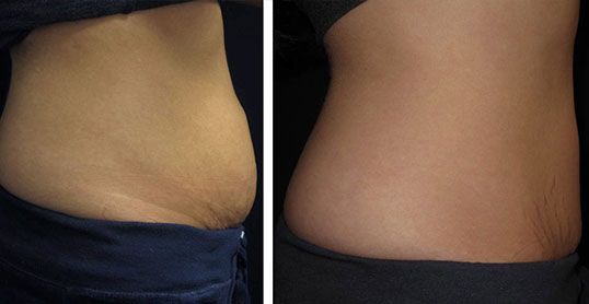 CoolSculpting Results