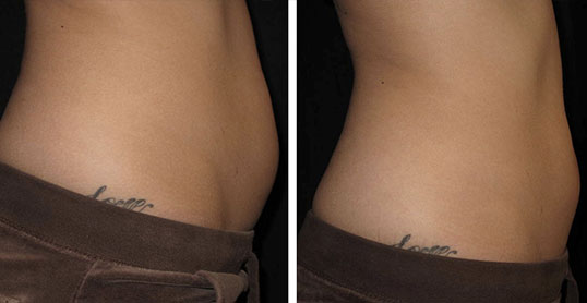 CoolSculpting Results