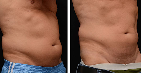 CoolSculpting Results