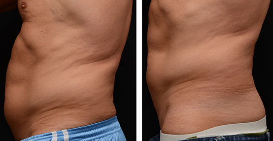 CoolSculpting Results