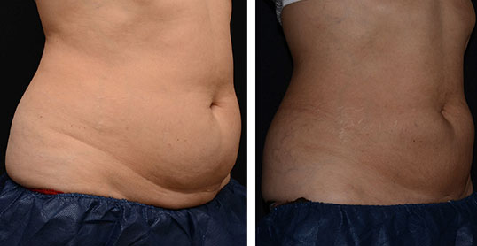 CoolSculpting Results