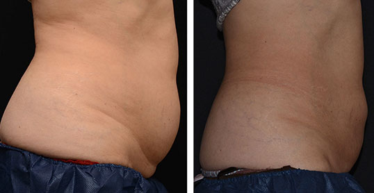 CoolSculpting Results