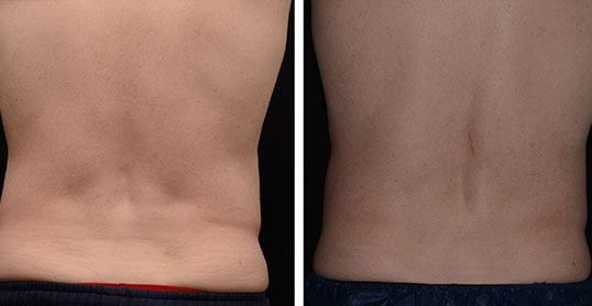 CoolSculpting Results