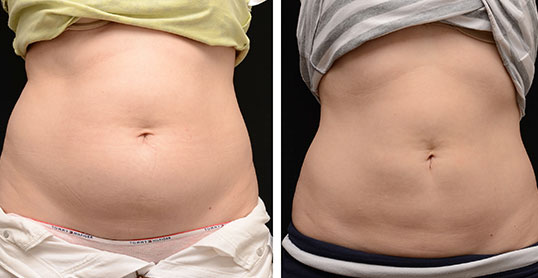 CoolSculpting Results