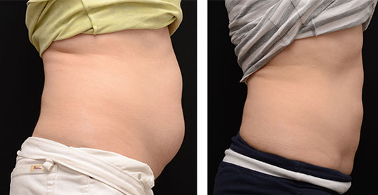 CoolSculpting Results