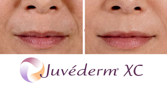 Dermal Fillers - juvederm XC results