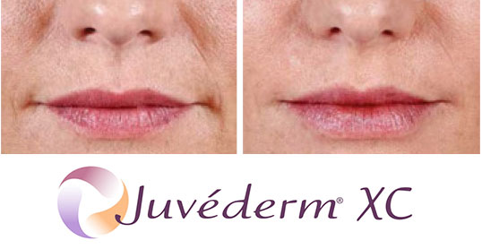 Dermal Fillers - juvederm XC results 2