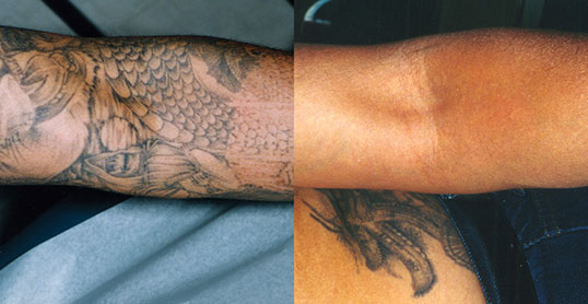 San Jose Tattoo Removal - wide 5