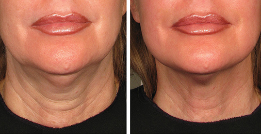 ultherapy results