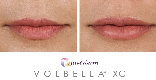 volbella results