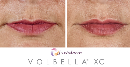 volbella results