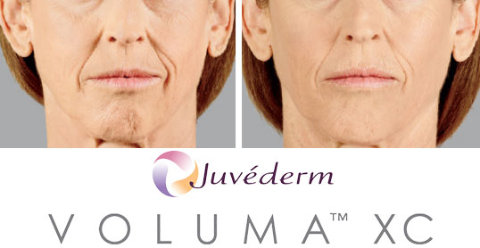 Dermall Fillers - Voluma Results