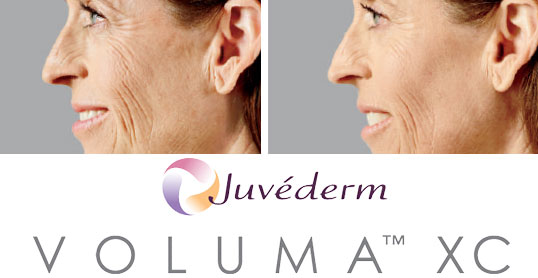 Dermal Fillers - voluma results 2