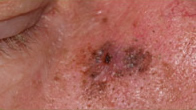 Melanoma