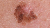 melanoma