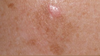 melanoma