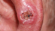 squamous cell carcinoma