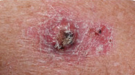 squamous cell carcinoma