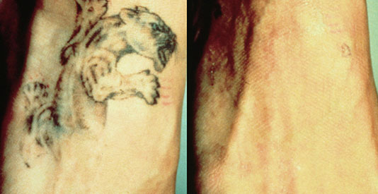 Tattoo Removal - Results 1