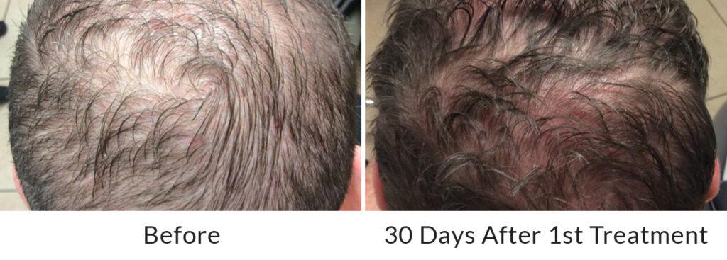 Hair Restoration Results