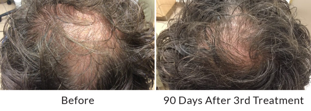 Hair Restoration Results