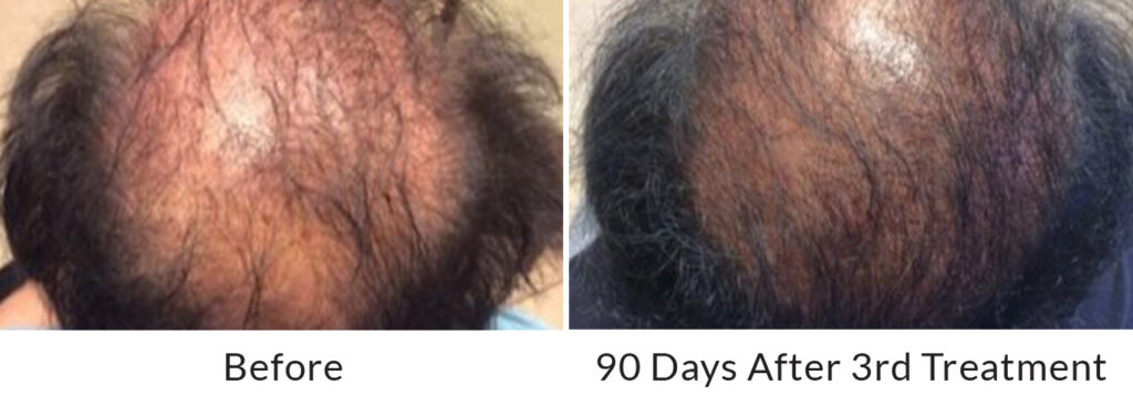 Hair Restoration Results