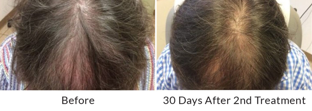 Hair Restoration | Regain Self-Esteem | Golden State Dermatology