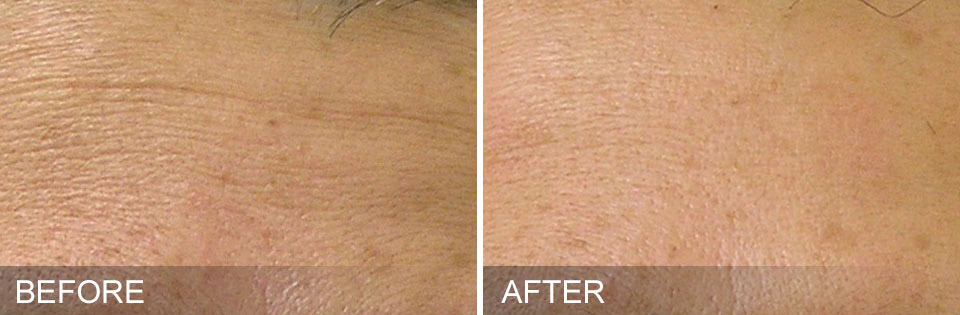 Hydrafacial - before & after Fine Lines