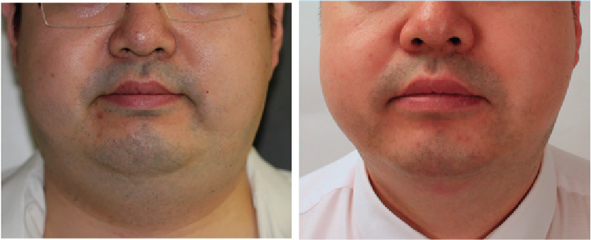 Agnes RF Double Chin Treatment