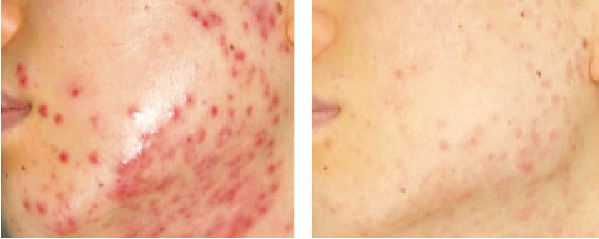 Agnes RF Acne Treatment