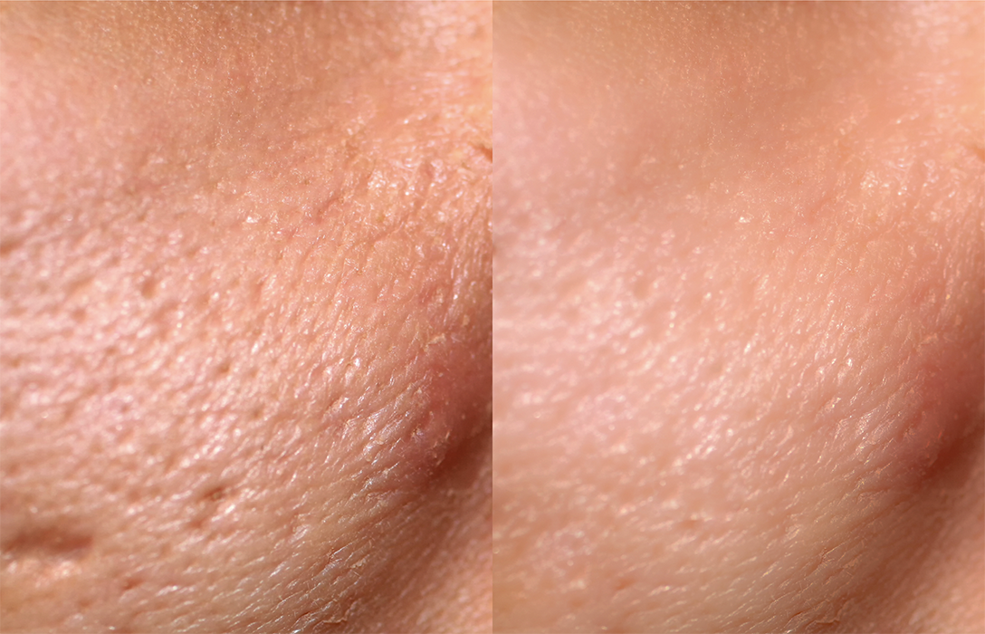 TCA Cross Acne Scar Treatment Skin Reconstruction