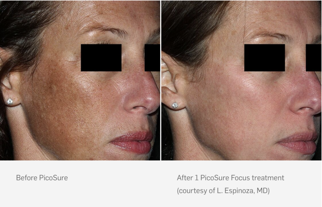 PicoSure Laser Results