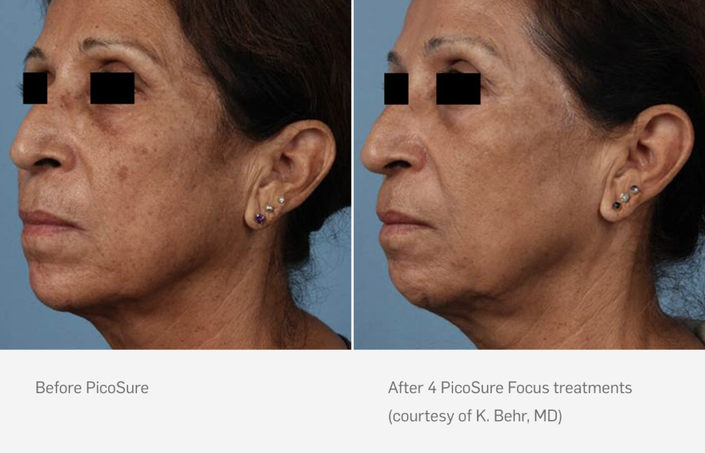 PicoSure Laser Result - 2