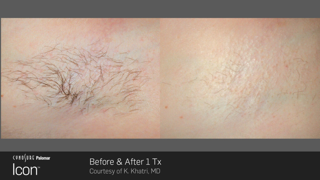 Laser Hair Removal - Before and After one treatment