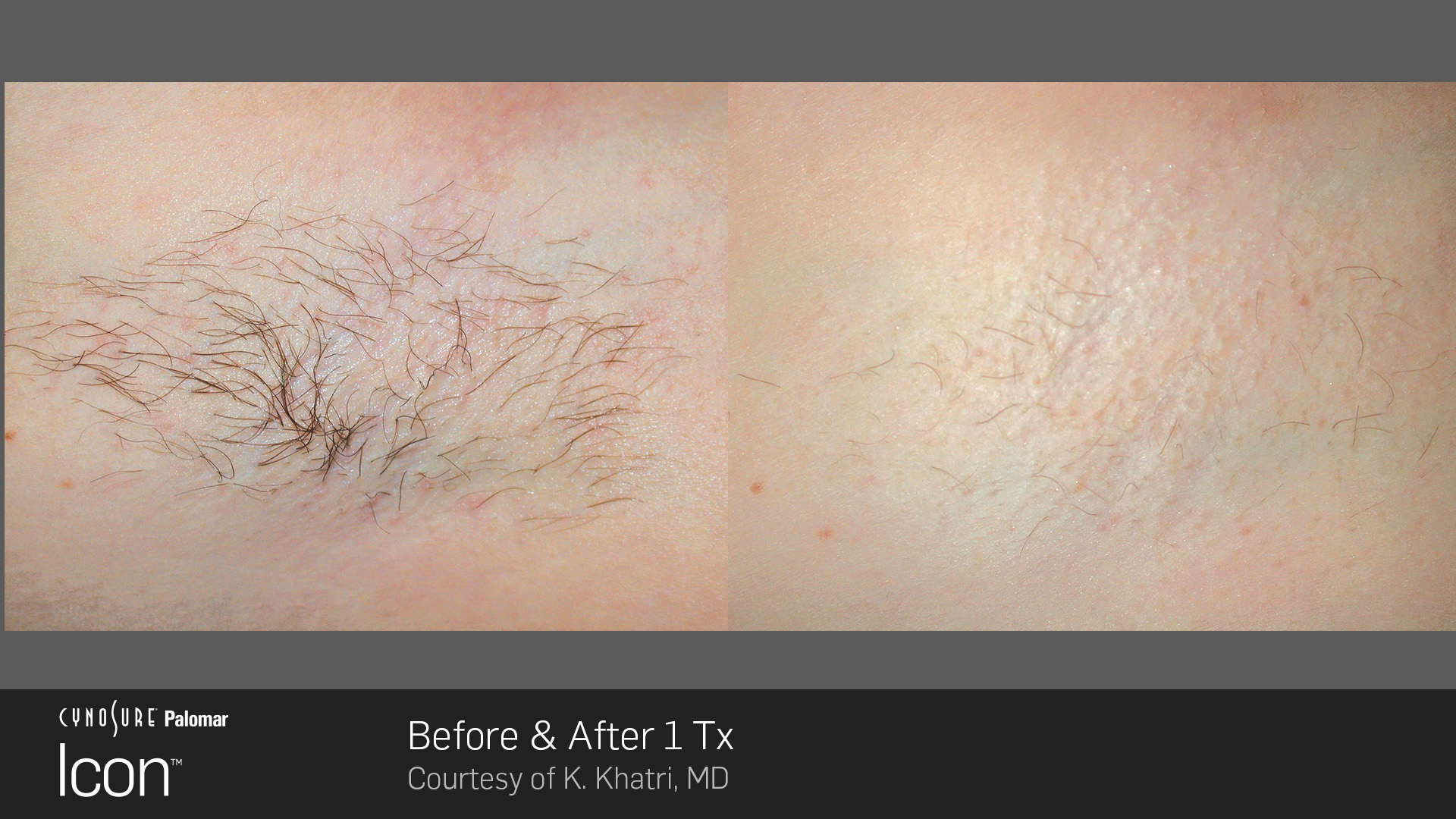 does oral glutathione affect laser hair removal The Benefits of Laser Hair Removal for Acne: Achieve Clear, Glowing Skin