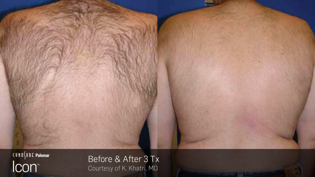 Laser Hair Removal - Before & After three treatments
