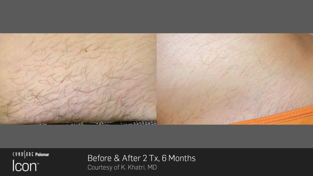 Laser Hair Removal - Before & After 2 Treatments, 6 Months