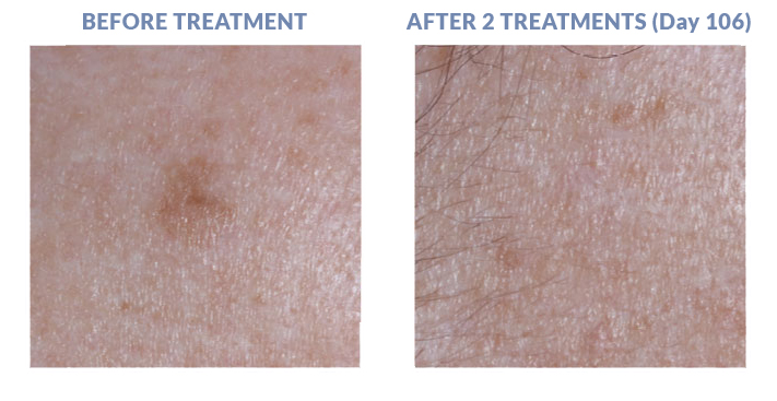 Seborrheic Keratoses - Results 2
