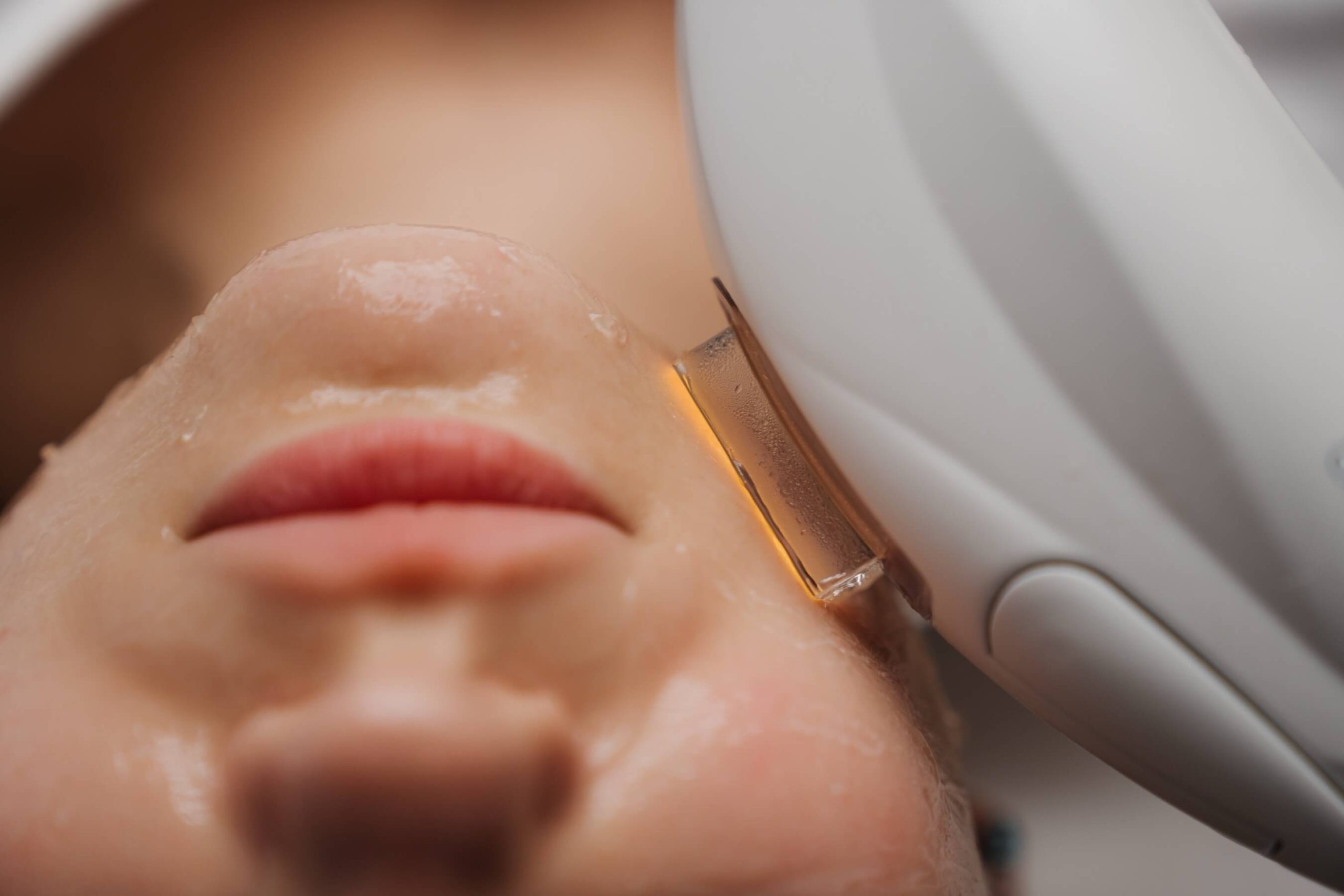 IPL FotoFacial | Sun Damage Reduction | Golden State Dermatology
