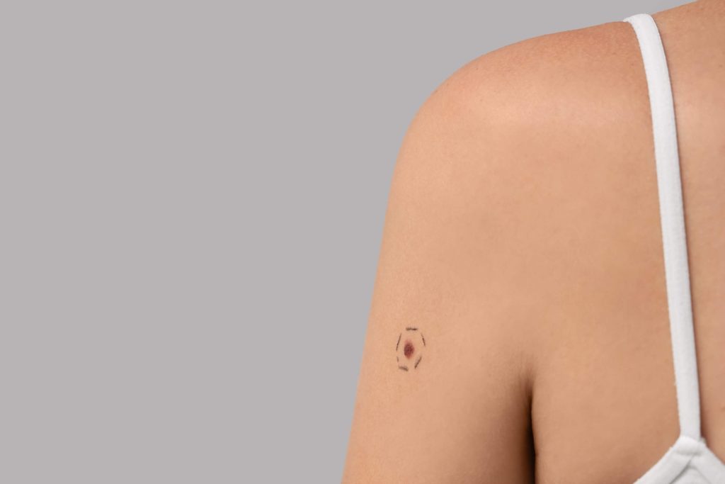 Young woman with a mole marked on her skin ahead of a removal procedure.