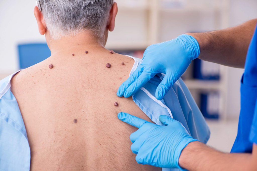 Older man consulting a dermatologist about a skin growth during an office visit.